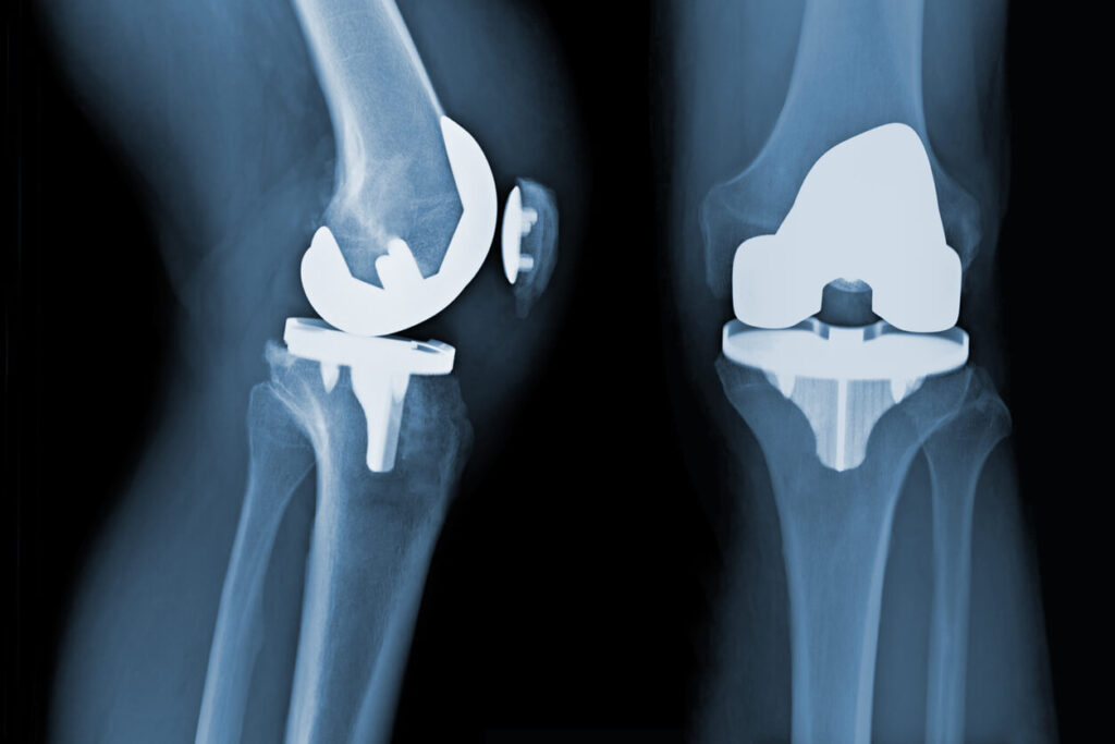 Knee Replacement Lawsuit – rdn Law – Find the Best Attorney